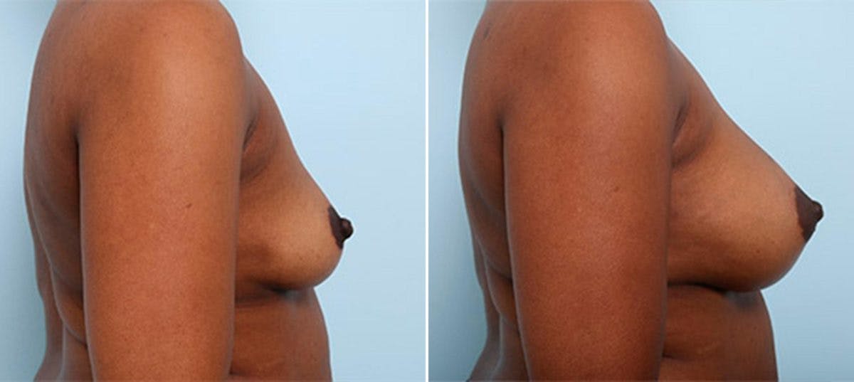 Breast Augmentation Before & After Gallery - Patient 54886963 - Image 3