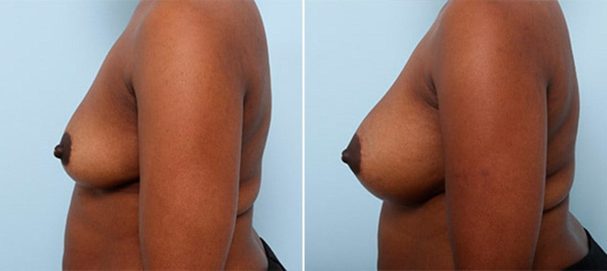 Breast Augmentation Before & After Gallery - Patient 54886963 - Image 5