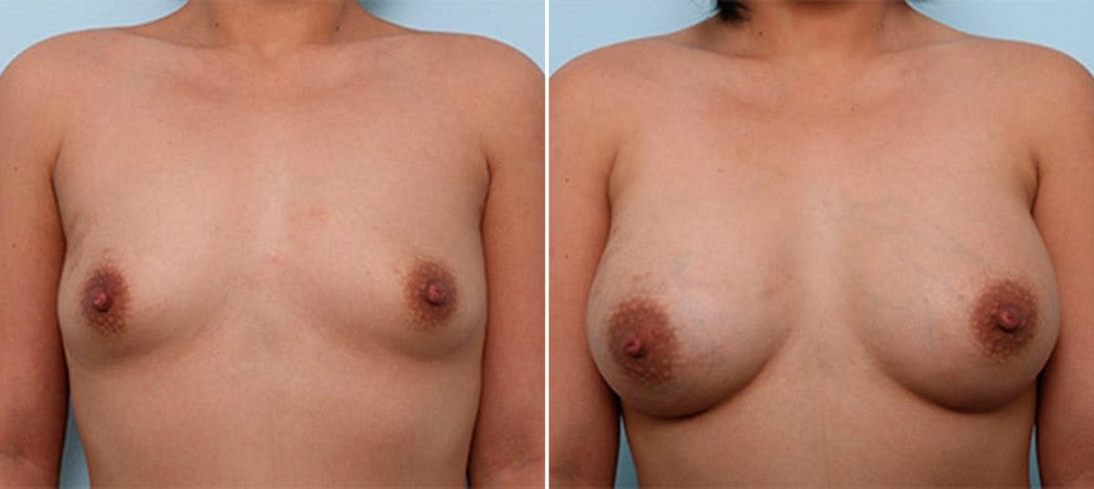Breast Augmentation Before & After Gallery - Patient 54886964 - Image 1