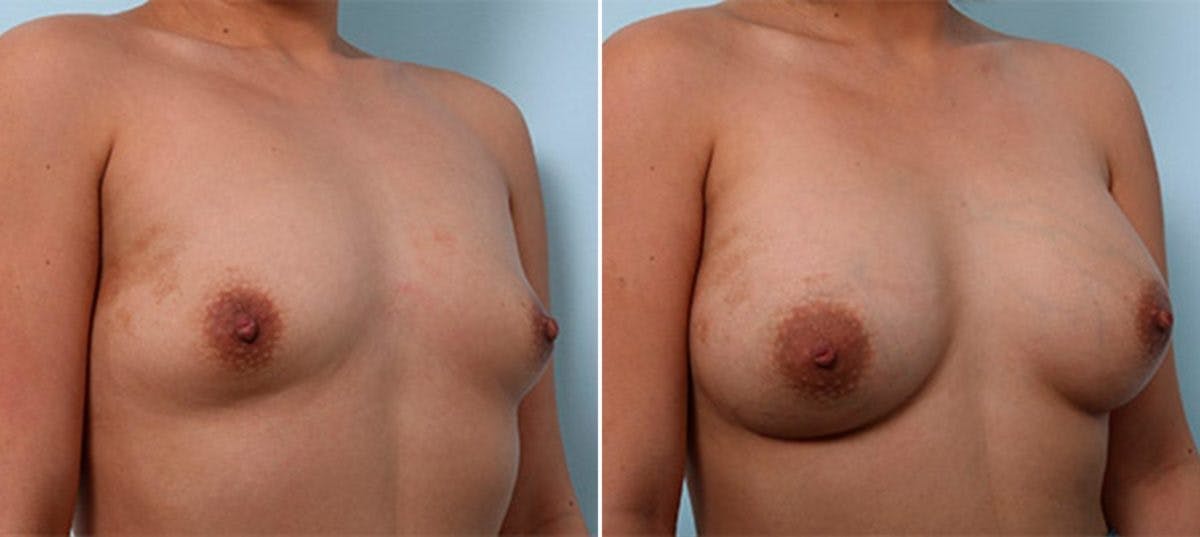 Breast Augmentation Before & After Gallery - Patient 54886964 - Image 2