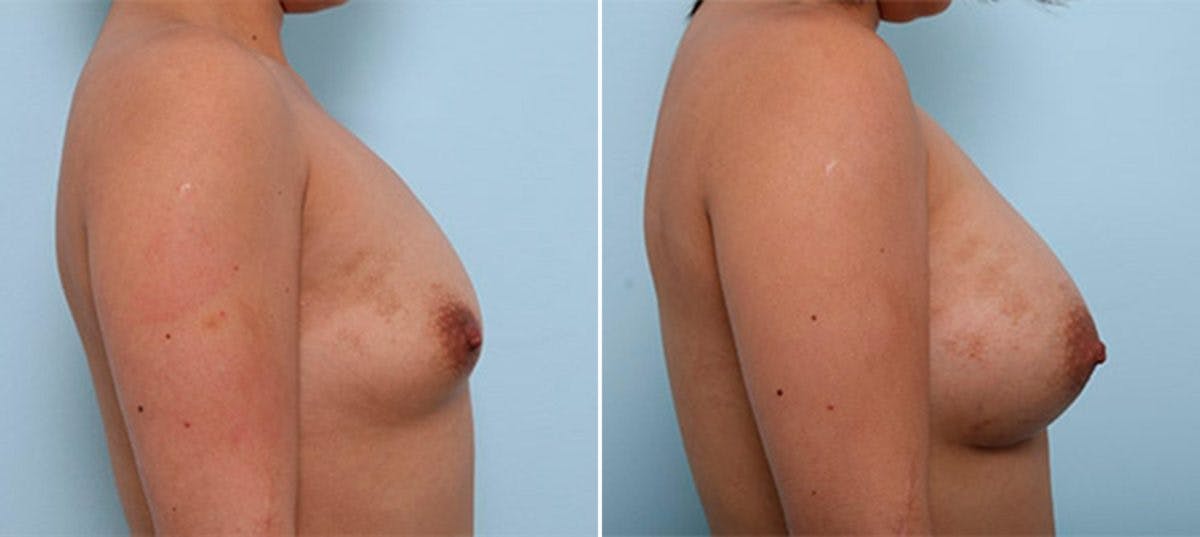 Breast Augmentation Before & After Gallery - Patient 54886964 - Image 3