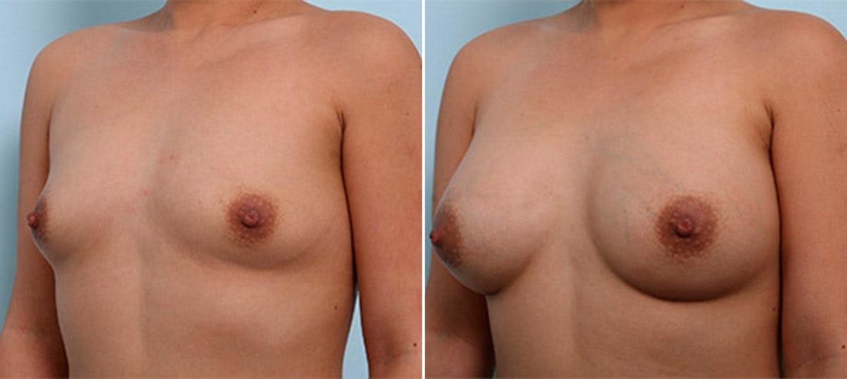 Breast Augmentation Before & After Photo - Patient 54886964 - Image 4