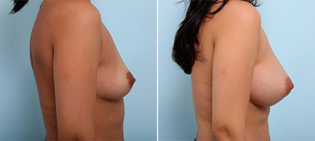 Breast Augmentation Before & After Gallery - Patient 54886965 - Image 3