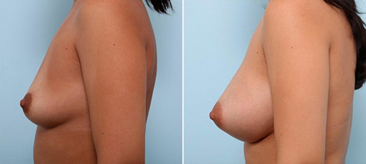 Breast Augmentation Before & After Gallery - Patient 54886965 - Image 5