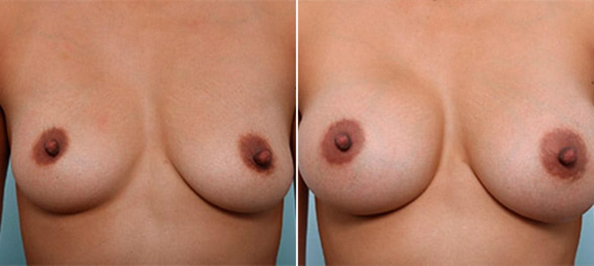Breast Augmentation Before & After Gallery - Patient 54886966 - Image 1