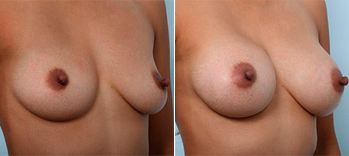 Breast Augmentation Before & After Gallery - Patient 54886966 - Image 2