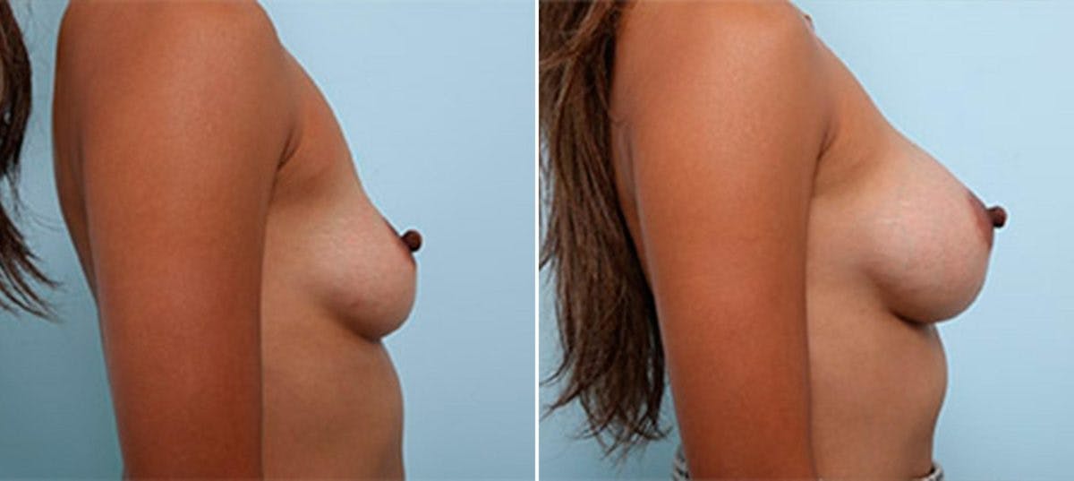 Breast Augmentation Before & After Gallery - Patient 54886966 - Image 3