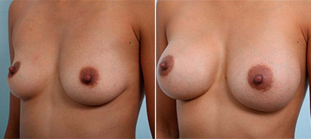 Breast Augmentation Before & After Gallery - Patient 54886966 - Image 4