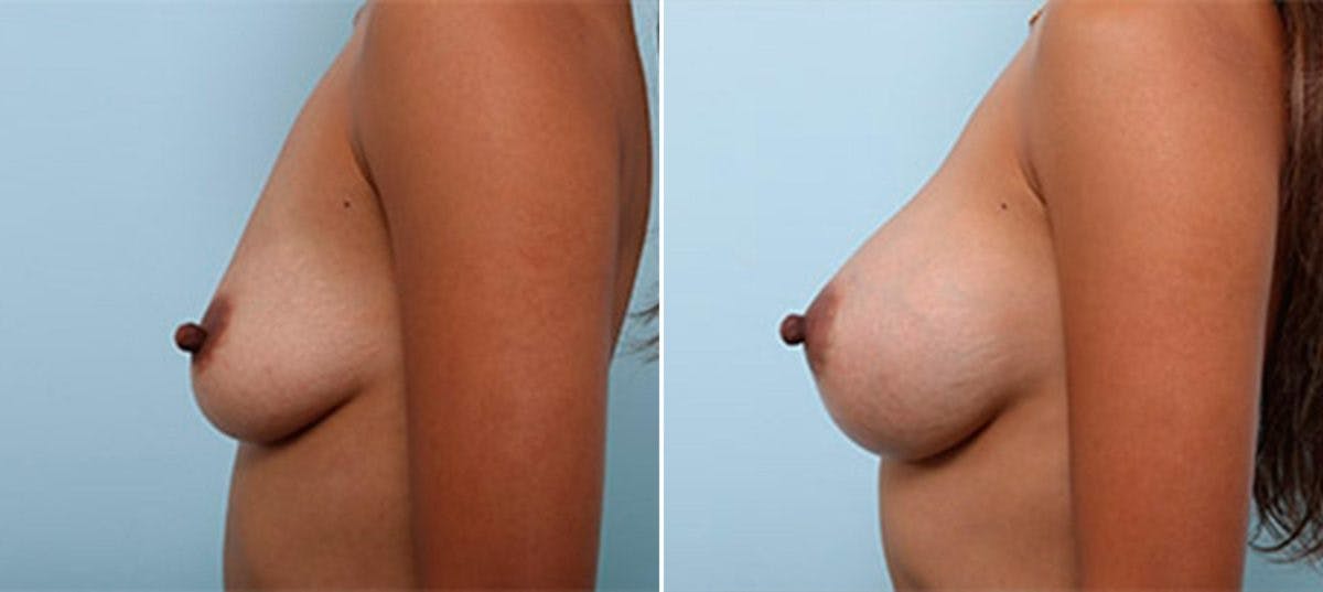 Breast Augmentation Before & After Gallery - Patient 54886966 - Image 5