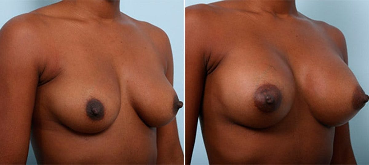 Breast Augmentation Before & After Gallery - Patient 54886967 - Image 2