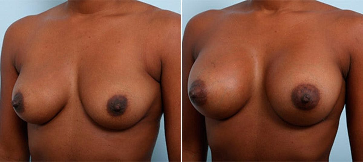 Breast Augmentation Before & After Gallery - Patient 54886967 - Image 4