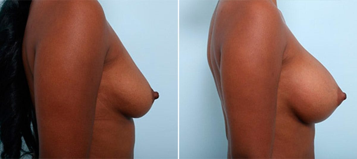 Breast Augmentation Before & After Gallery - Patient 54886968 - Image 3