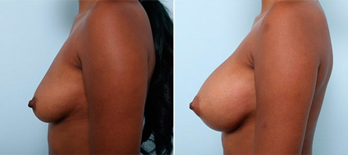 Breast Augmentation Before & After Gallery - Patient 54886968 - Image 5