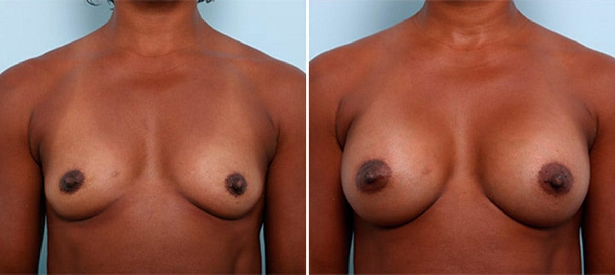 Breast Augmentation Before & After Gallery - Patient 54886971 - Image 1