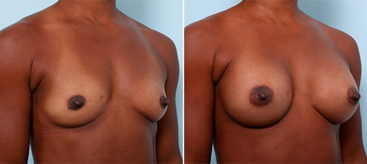 Breast Augmentation Before & After Gallery - Patient 54886971 - Image 2