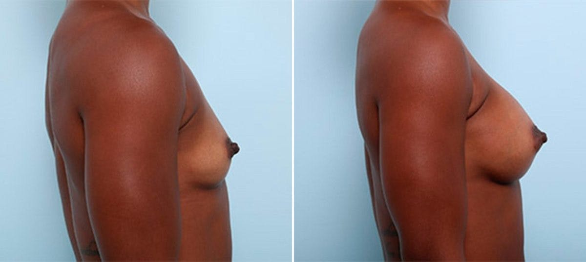 Breast Augmentation Before & After Gallery - Patient 54886971 - Image 3