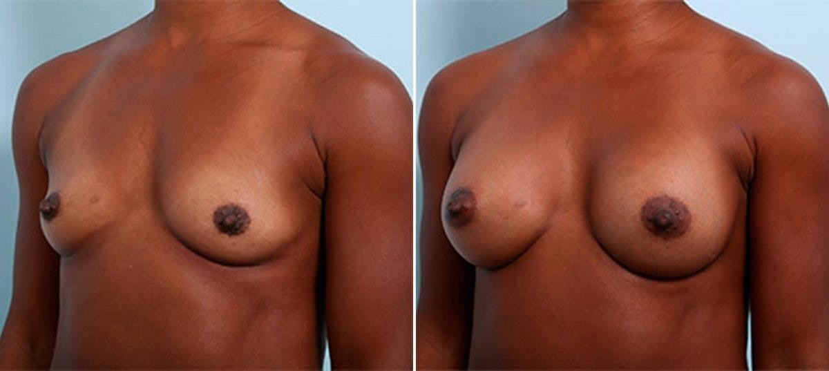 Breast Augmentation Before & After Gallery - Patient 54886971 - Image 4