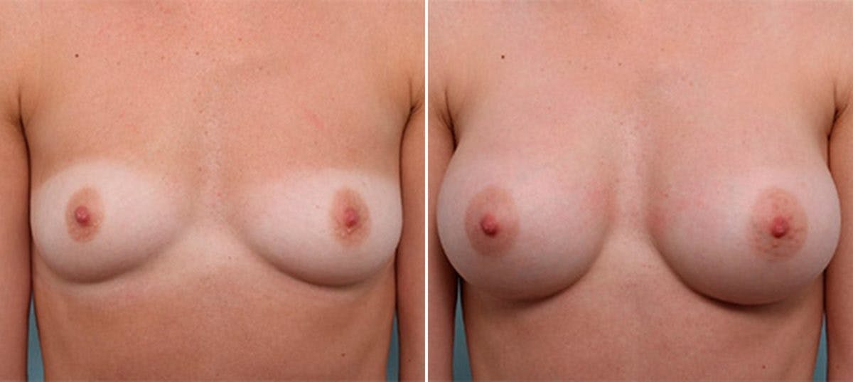 Breast Augmentation Before & After Gallery - Patient 54886973 - Image 1