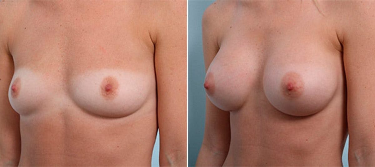 Breast Augmentation Before & After Gallery - Patient 54886973 - Image 4