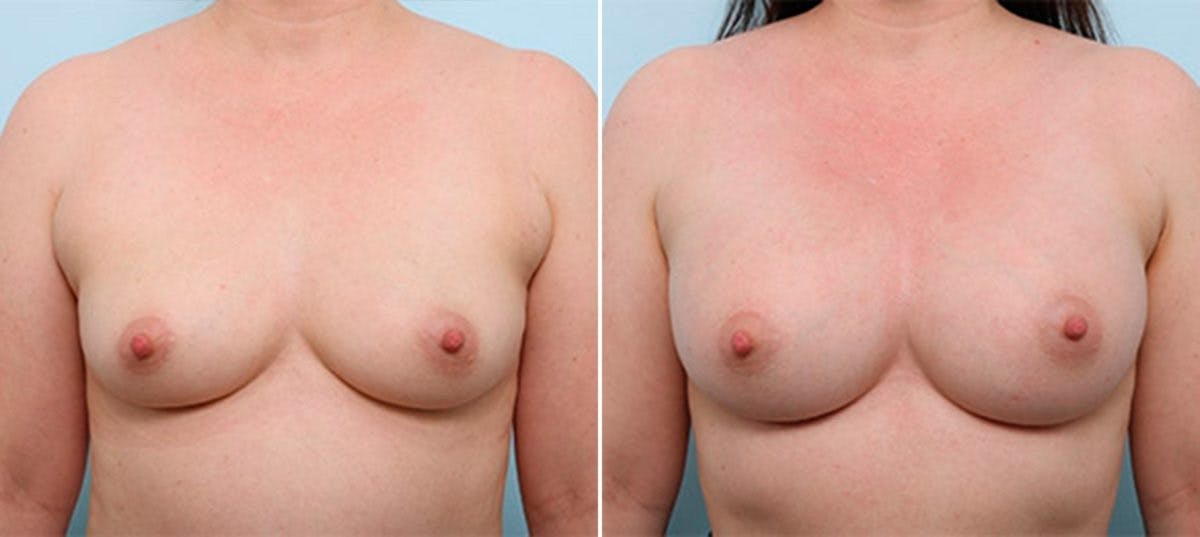Breast Augmentation Before & After Gallery - Patient 54886974 - Image 1
