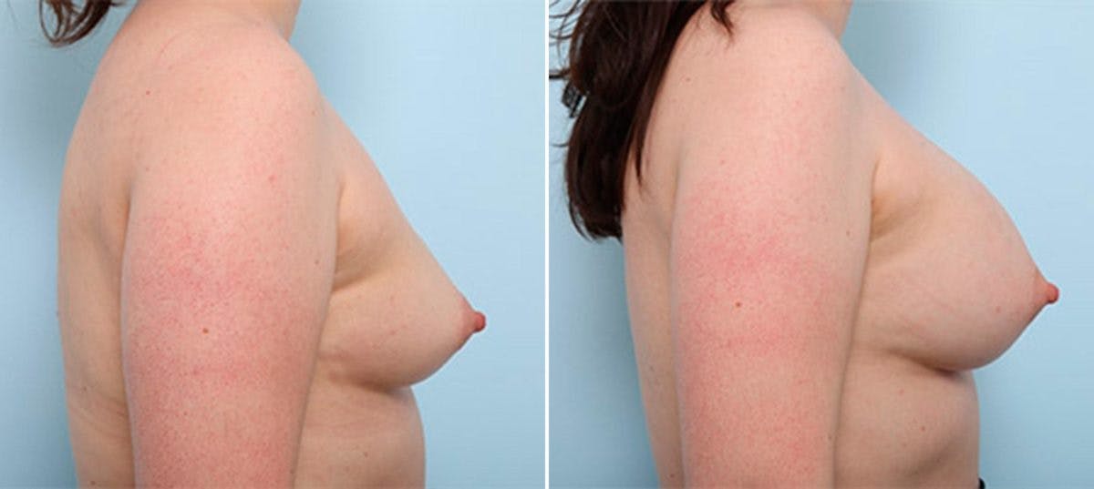 Breast Augmentation Before & After Gallery - Patient 54886974 - Image 3