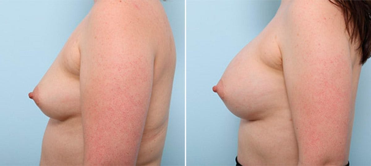 Breast Augmentation Before & After Gallery - Patient 54886974 - Image 5