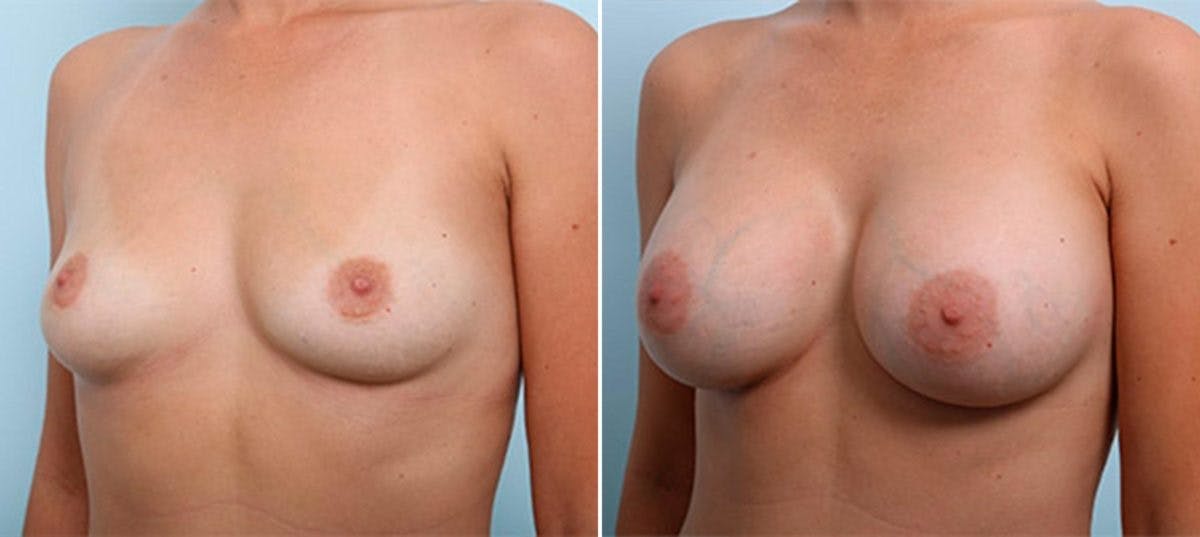 Breast Augmentation Before & After Gallery - Patient 54886975 - Image 4