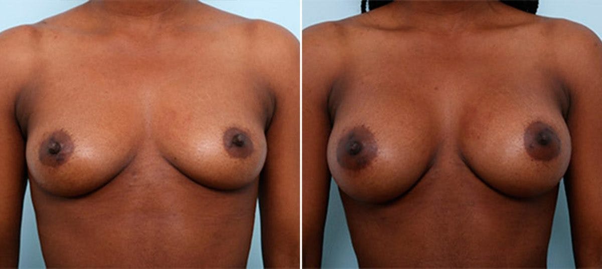 Breast Augmentation Before & After Gallery - Patient 54886978 - Image 1