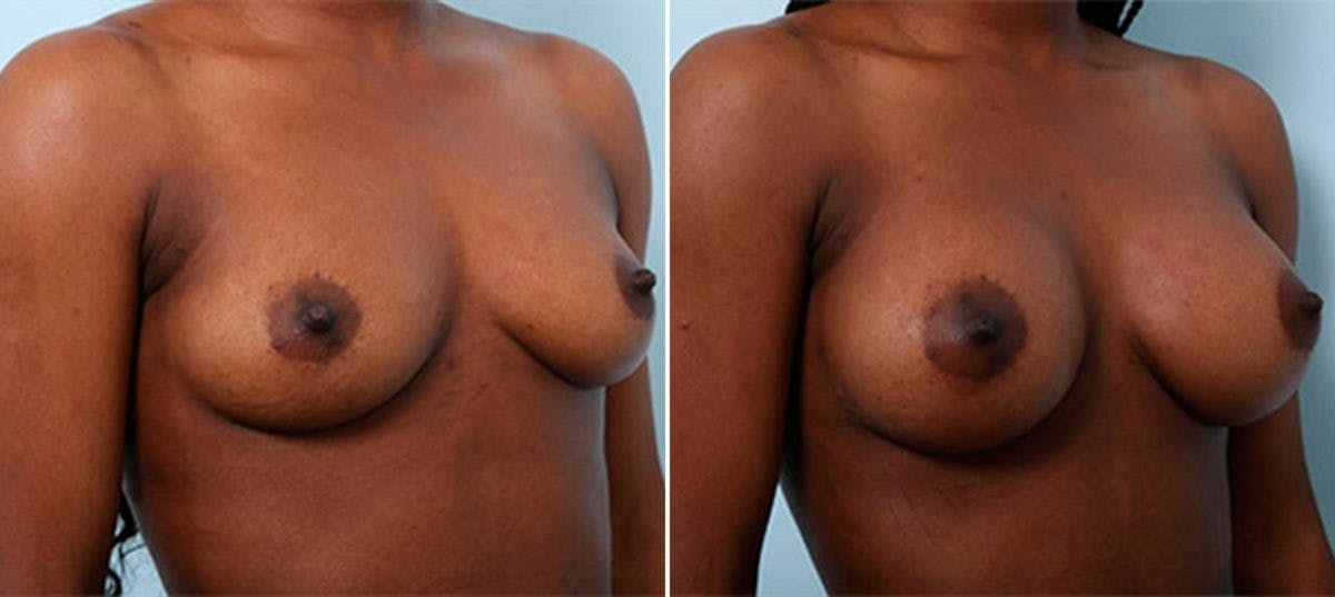 Breast Augmentation Before & After Gallery - Patient 54886978 - Image 2