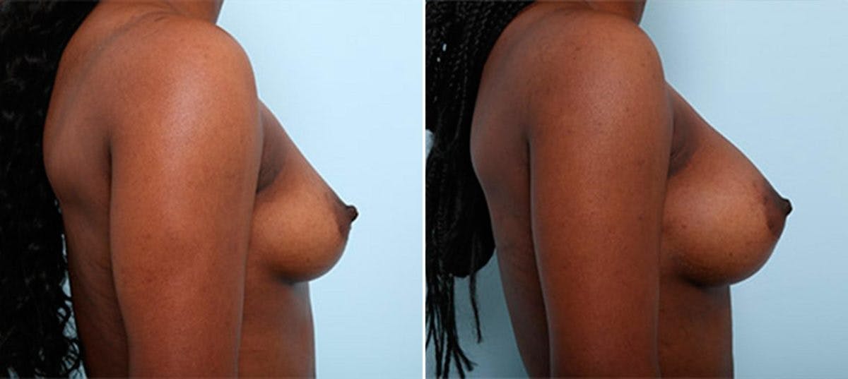 Breast Augmentation Before & After Gallery - Patient 54886978 - Image 3