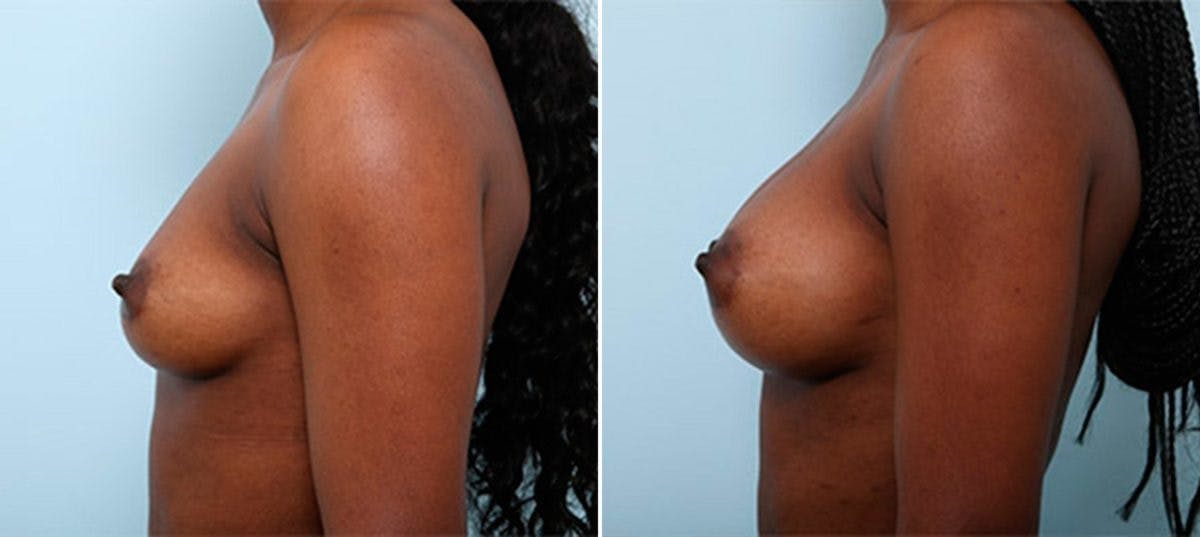 Breast Augmentation Before & After Gallery - Patient 54886978 - Image 5