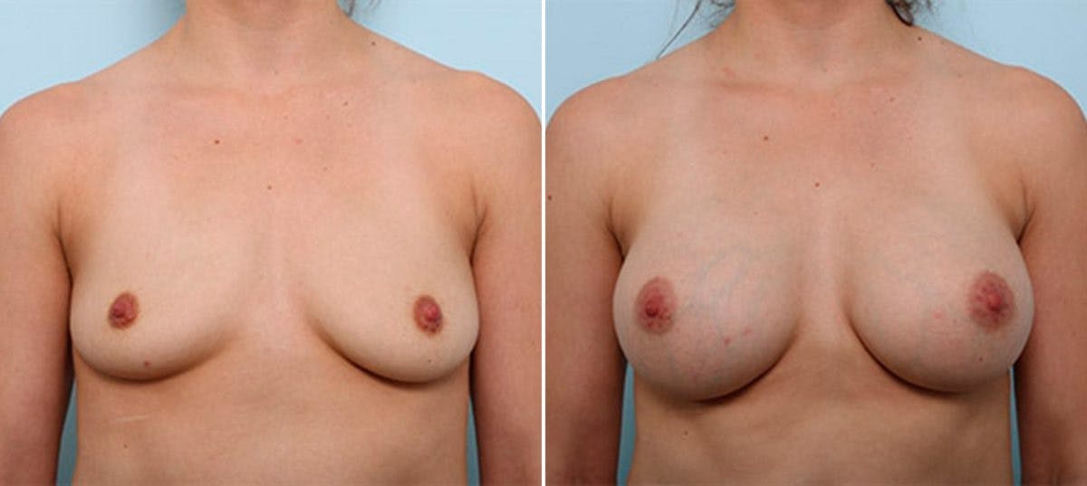 Breast Augmentation Before & After Gallery - Patient 54886980 - Image 1