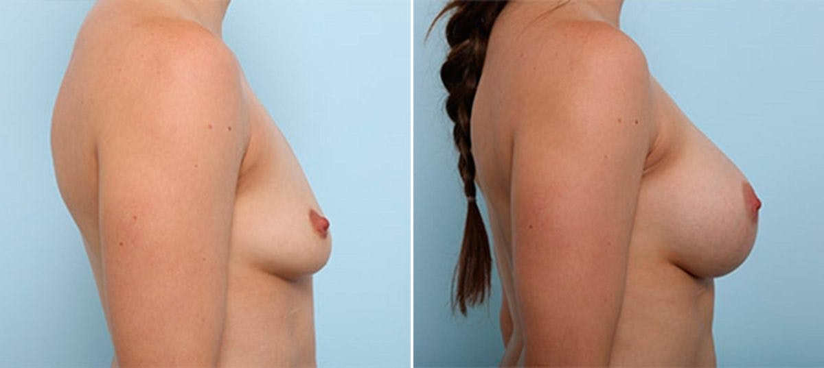 Breast Augmentation Before & After Gallery - Patient 54886980 - Image 3