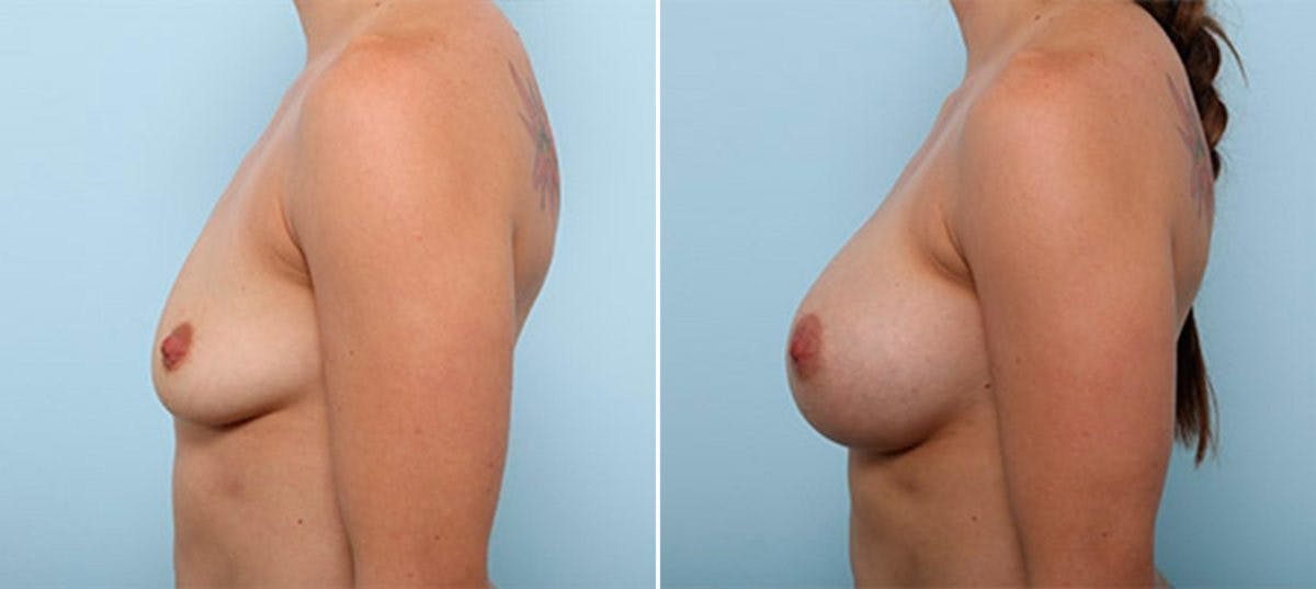 Breast Augmentation Before & After Gallery - Patient 54886980 - Image 5