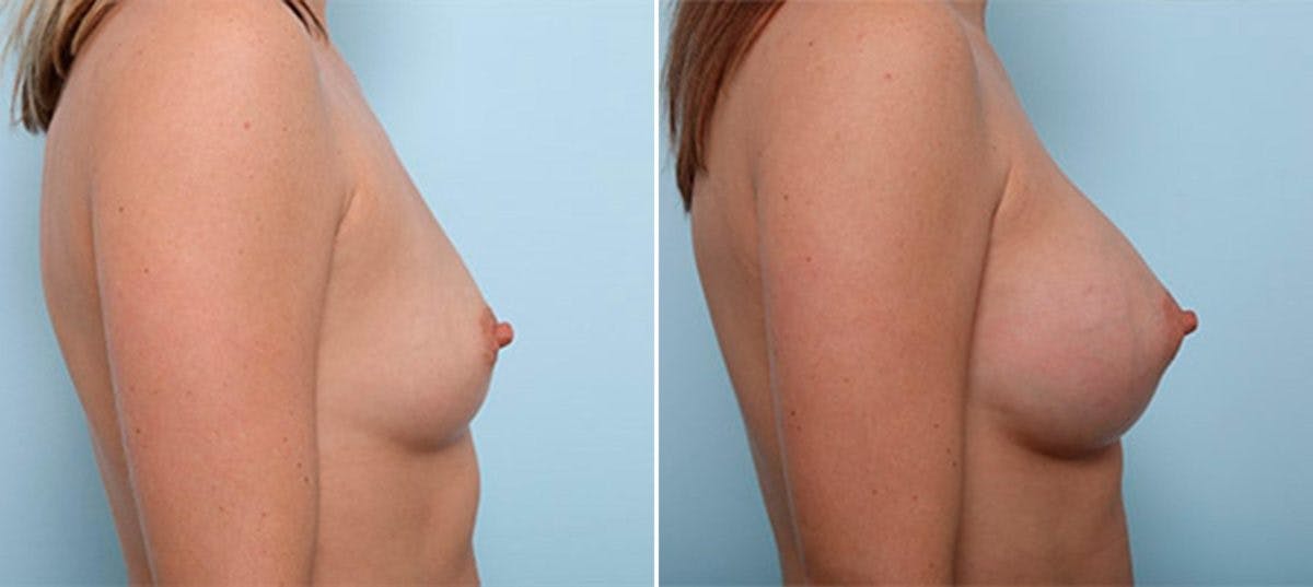 Breast Augmentation Before & After Gallery - Patient 54886983 - Image 3