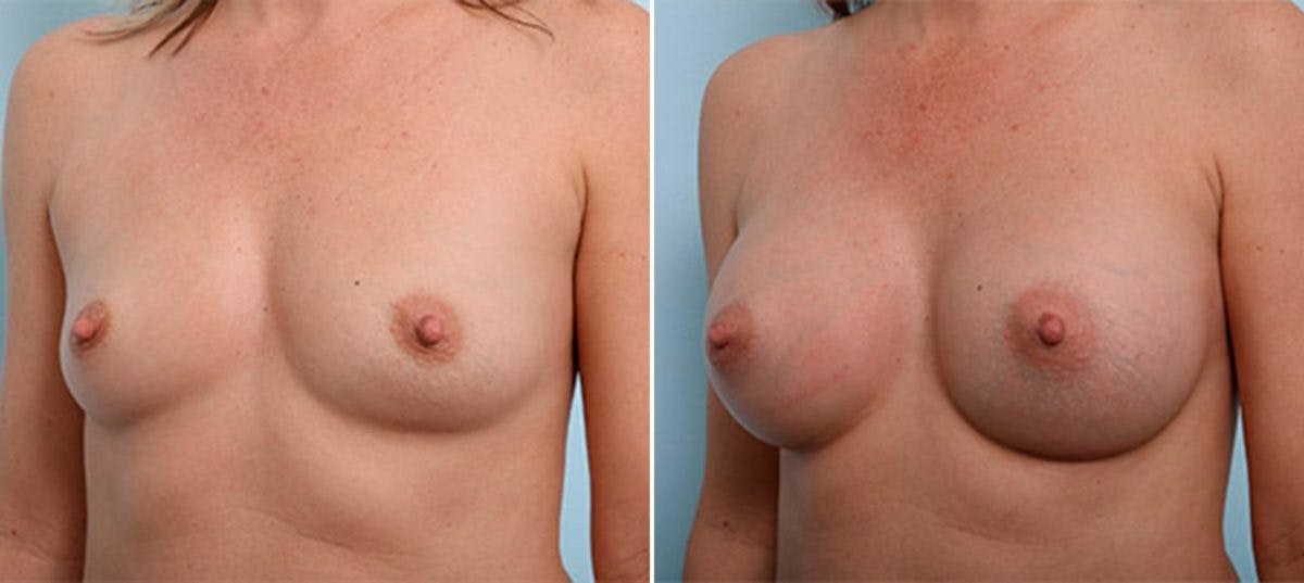 Breast Augmentation Before & After Gallery - Patient 54886983 - Image 4