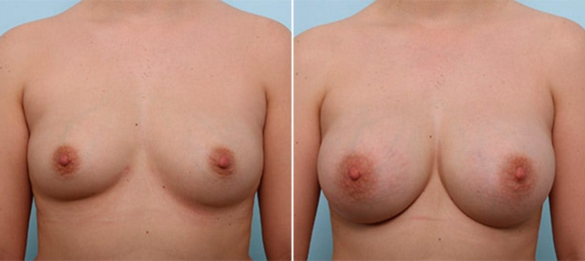 Breast Augmentation Before & After Gallery - Patient 54886986 - Image 1
