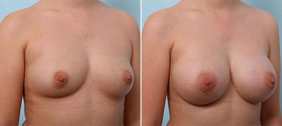 Breast Augmentation Before & After Gallery - Patient 54886986 - Image 2