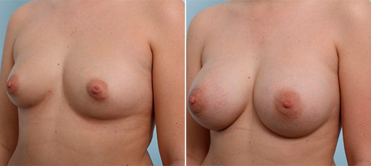 Breast Augmentation Before & After Gallery - Patient 54886986 - Image 4
