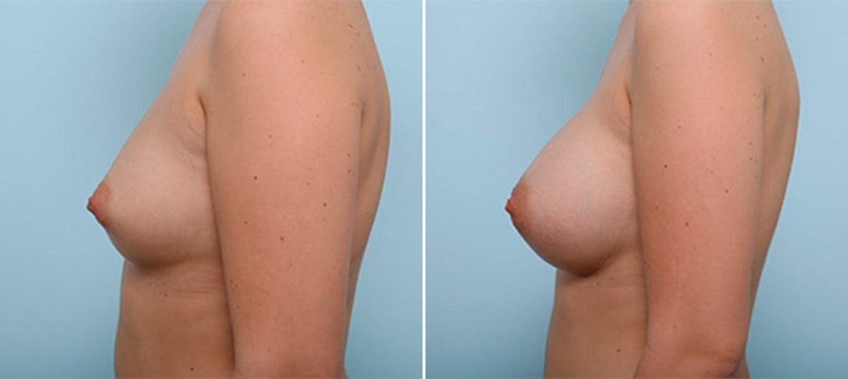 Breast Augmentation Before & After Gallery - Patient 54886986 - Image 5