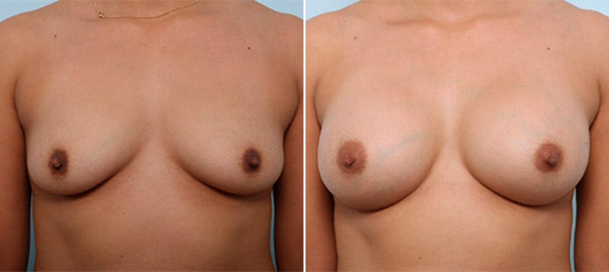 Breast Augmentation Before & After Gallery - Patient 54886987 - Image 1