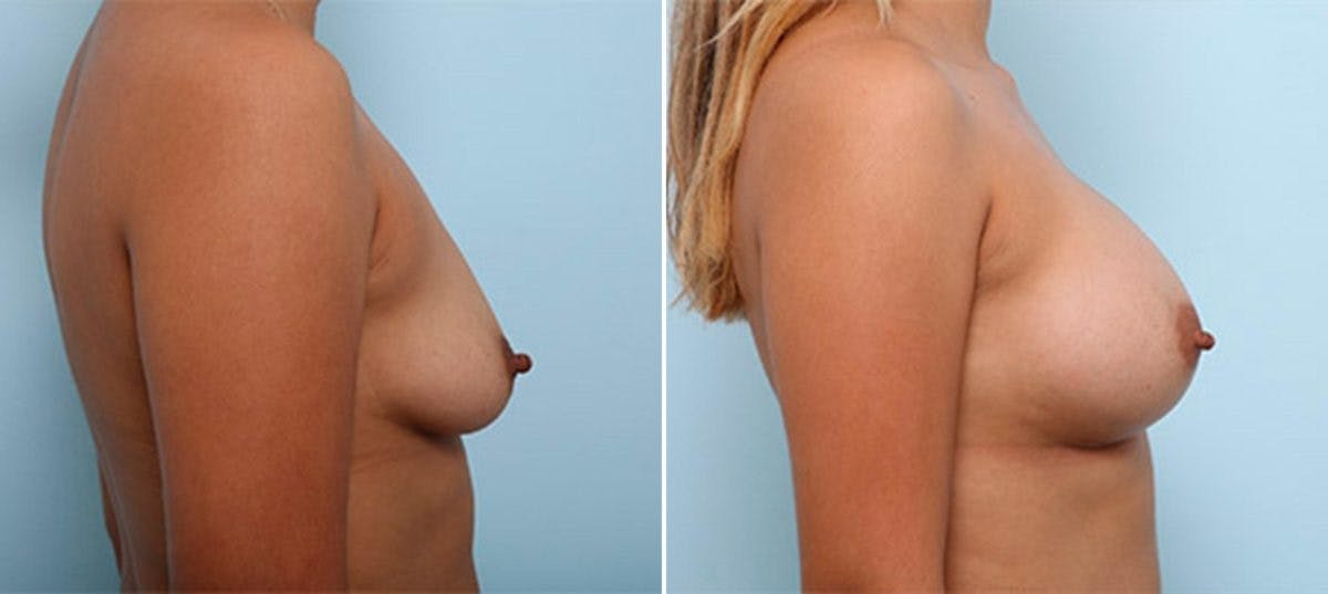 Breast Augmentation Before & After Gallery - Patient 54886987 - Image 3
