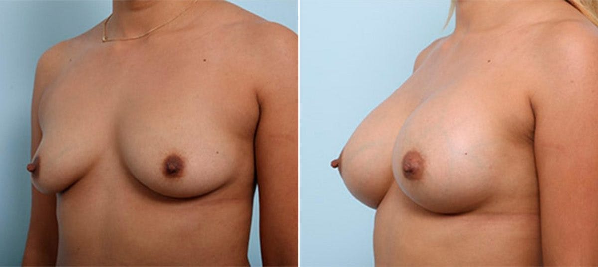 Breast Augmentation Before & After Gallery - Patient 54886987 - Image 4