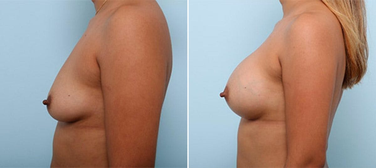 Breast Augmentation Before & After Gallery - Patient 54886987 - Image 5