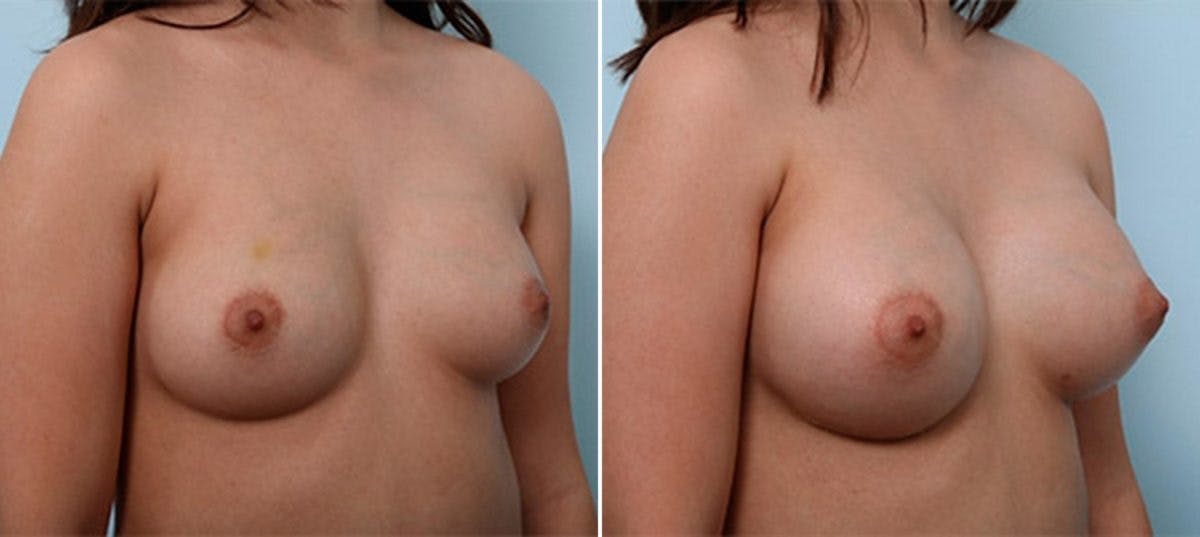 Breast Augmentation Before & After Gallery - Patient 54886988 - Image 2