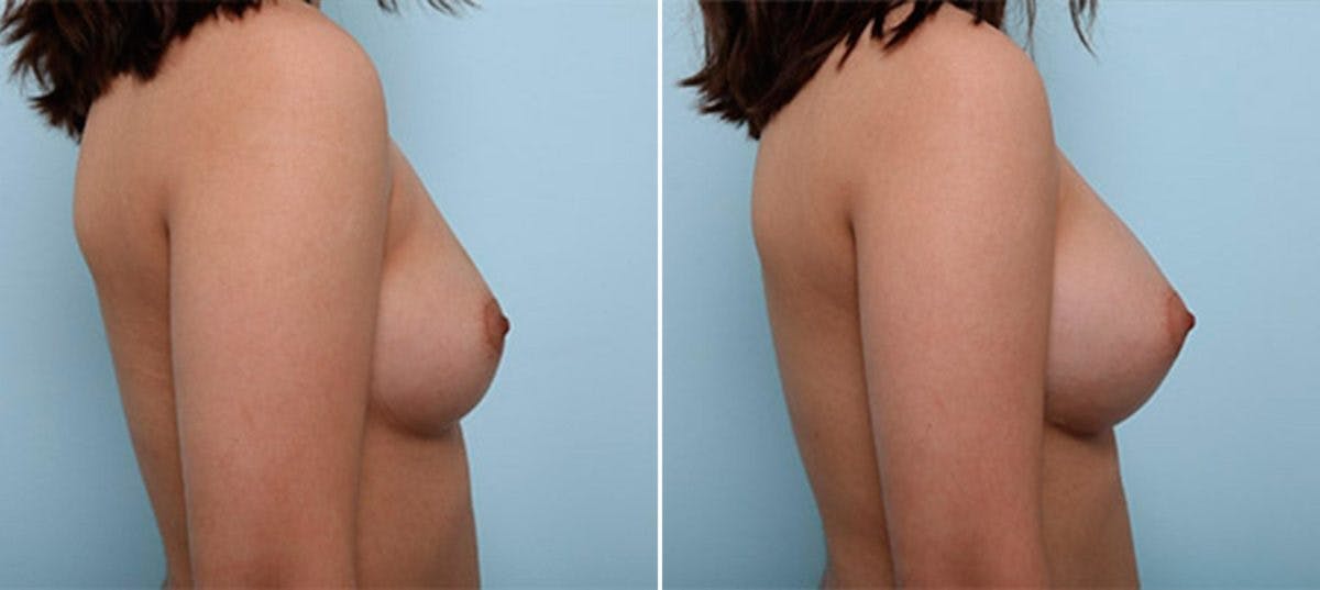 Breast Augmentation Before & After Gallery - Patient 54886988 - Image 3