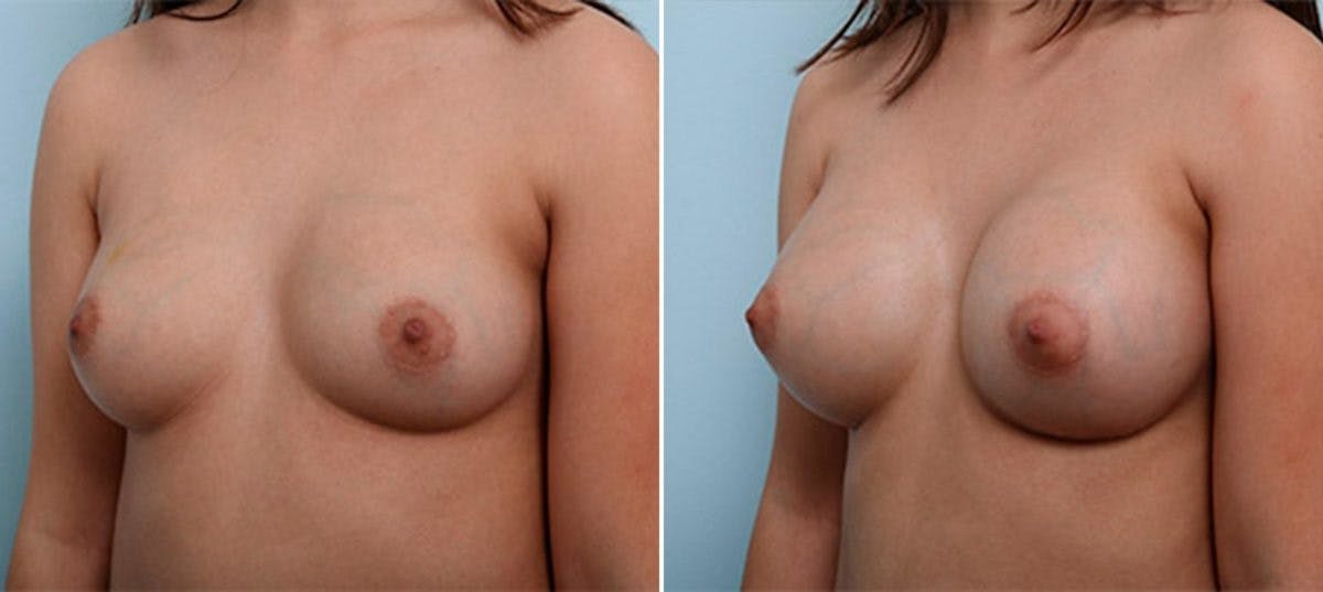 Breast Augmentation Before & After Gallery - Patient 54886988 - Image 4