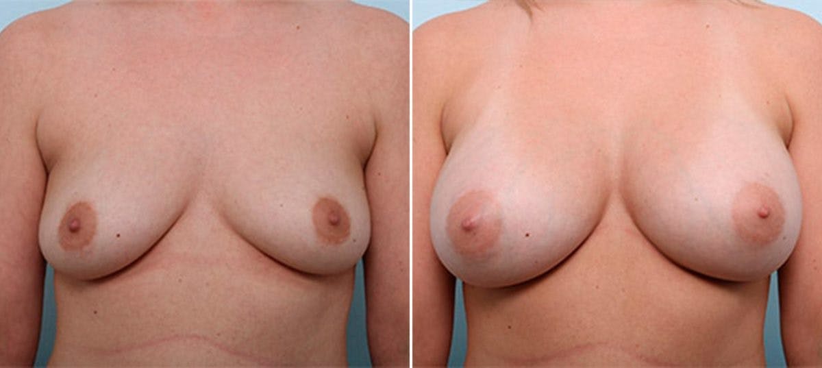 Breast Augmentation Before & After Gallery - Patient 54886990 - Image 1