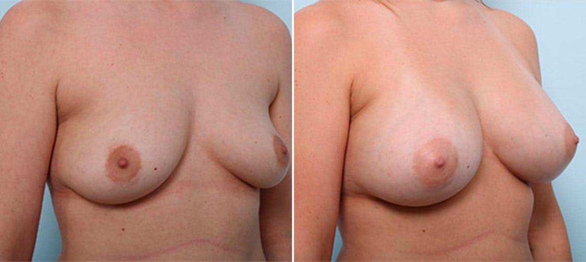 Breast Augmentation Before & After Gallery - Patient 54886990 - Image 2