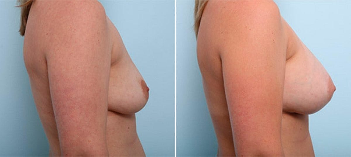 Breast Augmentation Before & After Gallery - Patient 54886990 - Image 3